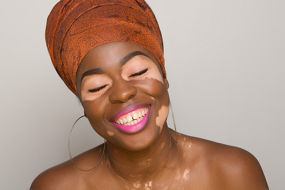 Bahamas Vitiligo Shoot