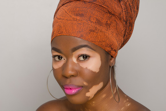 Bahamas Vitiligo Shoot